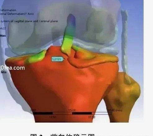官方：高迪左膝内侧半月板后角撕裂，恢复时间为4周